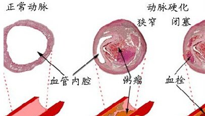 動(dòng)脈硬化